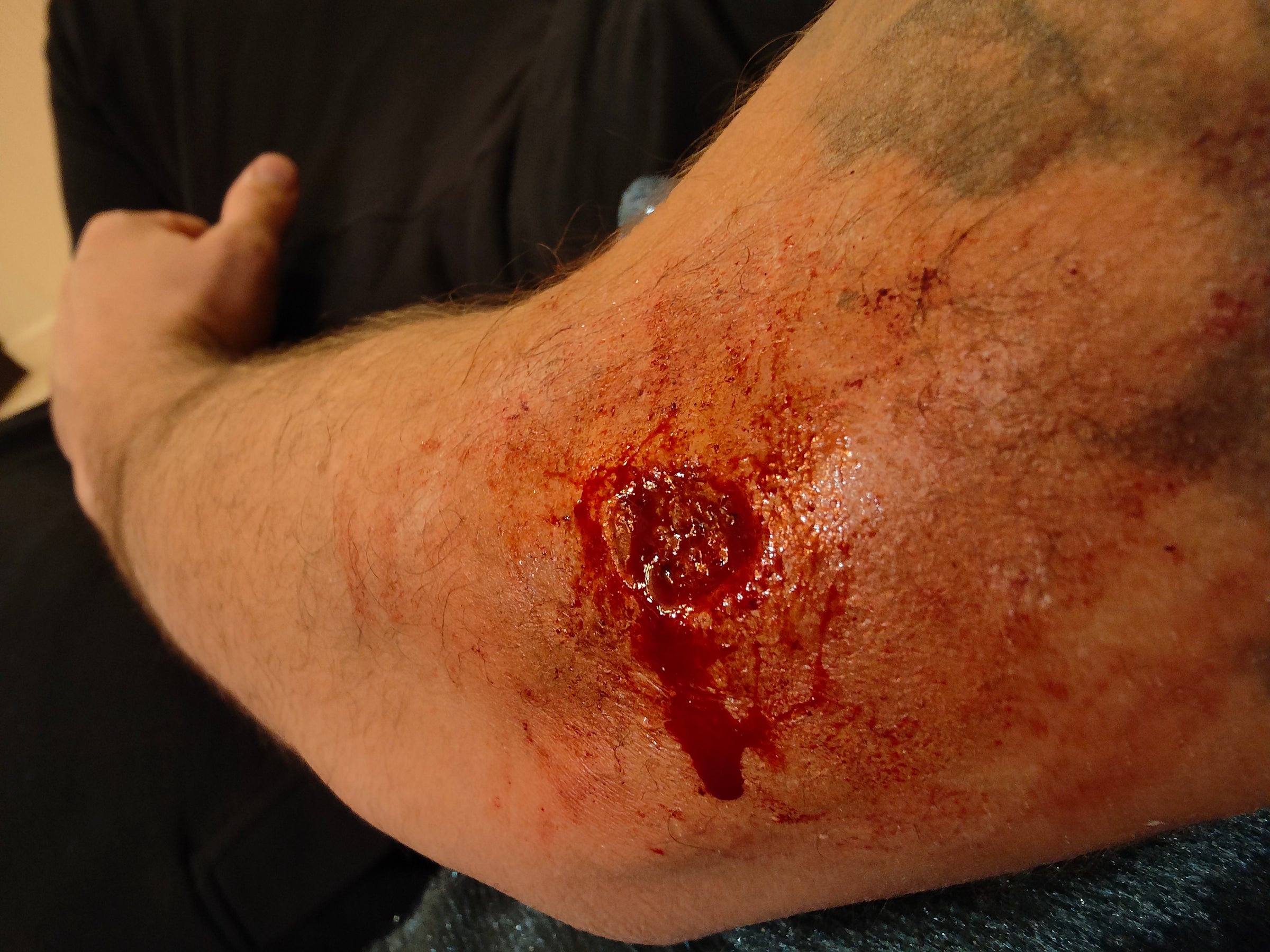 Bullet Wounds